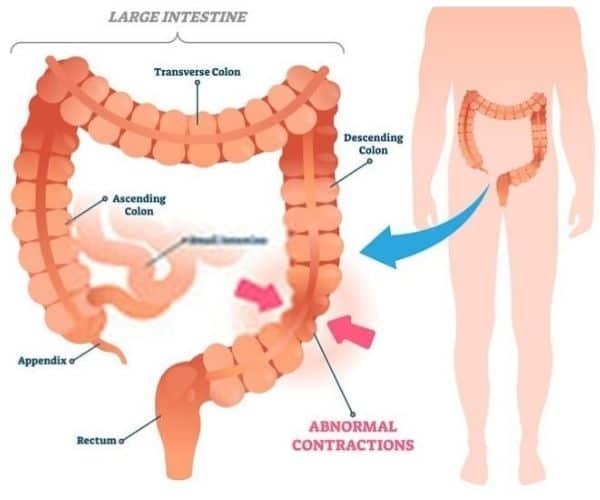IBS irritable bowel syndrome illustration