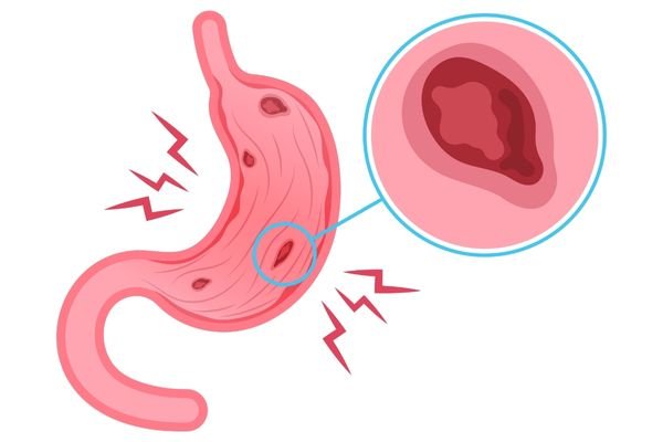 peptic ulcers